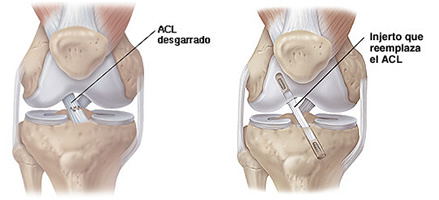 Artroscopia rodilla: ligamentos