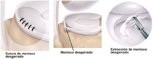 Artroscopia rodilla: meniscos