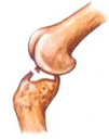 Lesión rodilla: Ligamento cruzado anterior