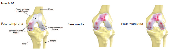 Atritis rodilla