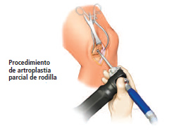 Atritis rodilla: artroplastia