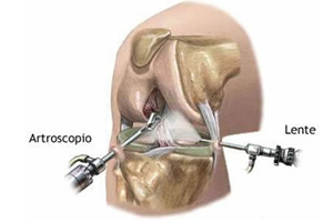 Artroscopia rodilla