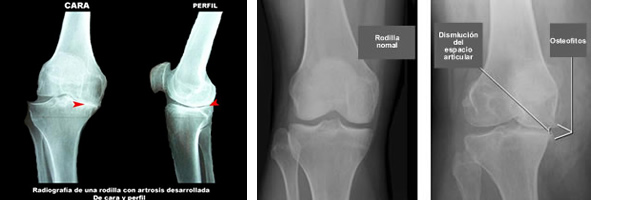 Artrosis rodilla