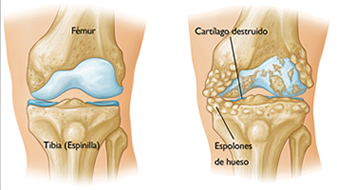 Artrosis de rodilla