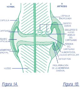 Artrosis en rodilla
