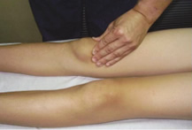 Fisioterapia rodilla: rótula