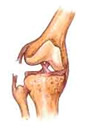 Lesión rodilla: Ligamento lateral externo