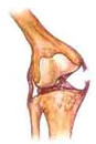 Lesión rodilla: Ligamento lateral interno
