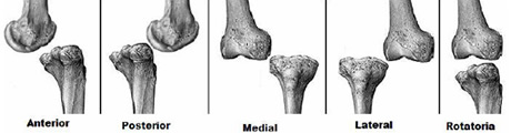 Luxación rodilla: dolor rodilla