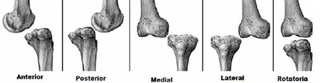 Luxación rodilla: dolor rodilla Luxación rodilla: dolor rodilla