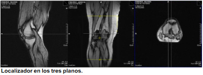 Resonancia rodilla: resonancia magnética rodilla