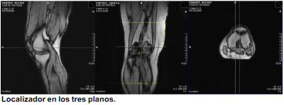 Resonancia rodilla: resonancia magnética rodilla Resonancia rodilla: resonancia magnética rodilla