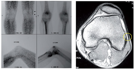 Rodilla del corredor