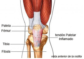 Tendinitis rodilla Tendinitis rodilla