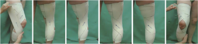 Vendaje rodilla: dolor de rodilla Vendaje rodilla: dolor de rodilla